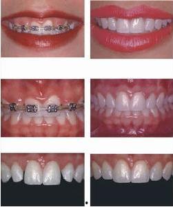 成人枕骨怎么矫正视频,成人枕骨矫正方法解析