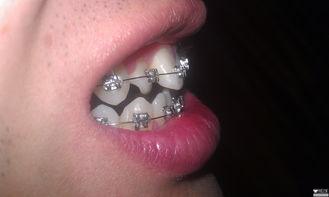 成人枕骨怎么矫正视频,成人枕骨矫正方法解析