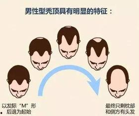 成人脱发搞笑视频大全,搞笑视频大盘点，笑出腹肌的脱发瞬间