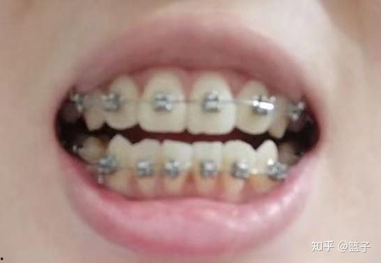 成人双排牙矫正视频,跟随视频见证蜕变之旅