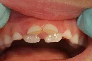 成人双排牙矫正视频,跟随视频见证蜕变之旅