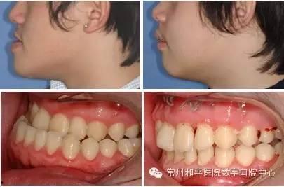 成人牙弓歪斜怎么矫正视频,视频教程深度解读