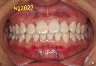 成人牙弓歪斜怎么矫正视频,视频教程深度解读