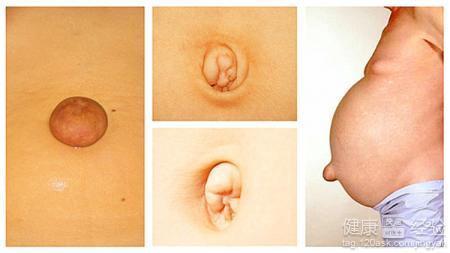 成人脐疝手术视频,成人脐疝手术全过程解析与要点回顾